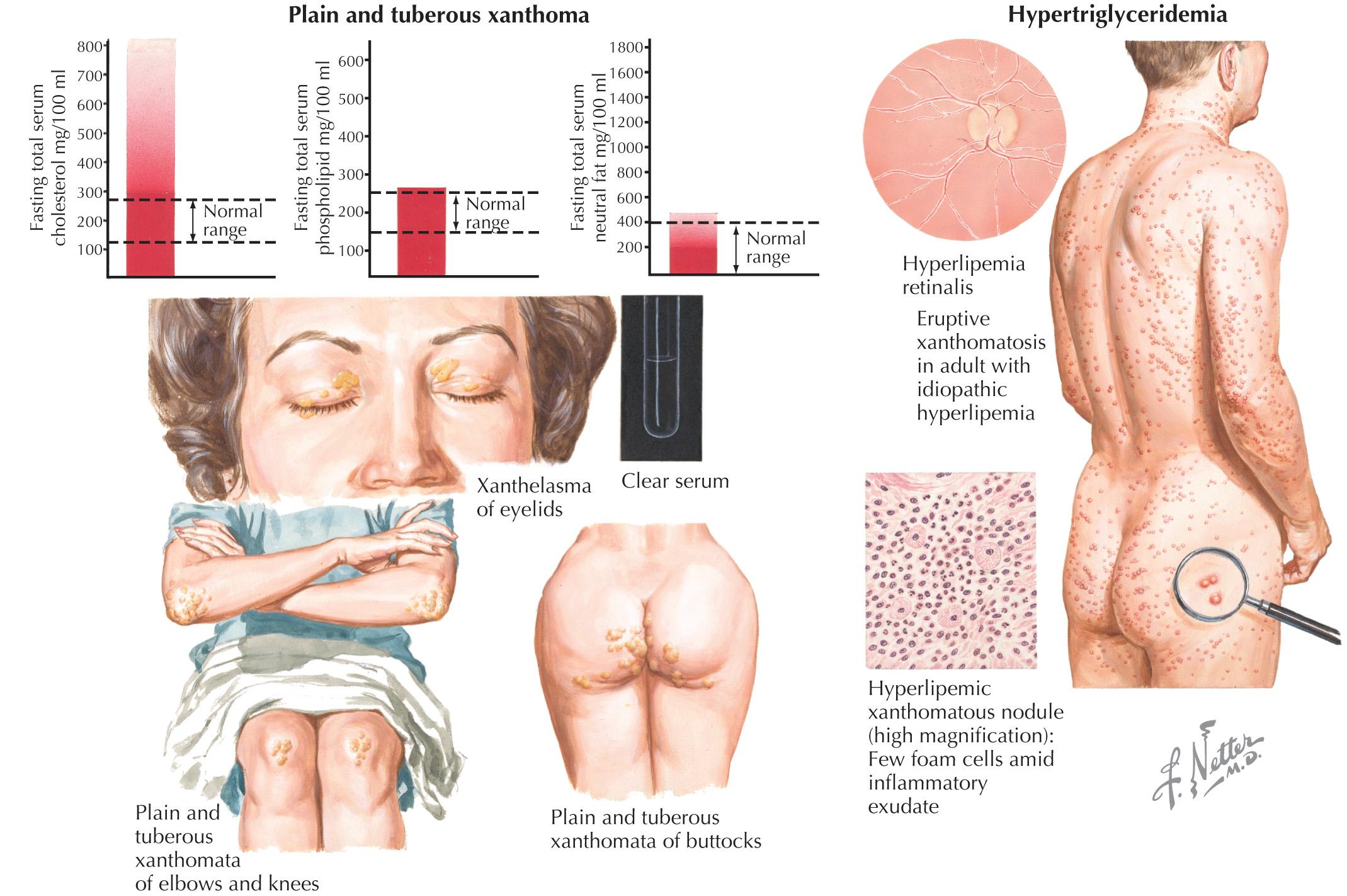 FIG 19.4, Hypercholesterolemic Xanthomatosis.