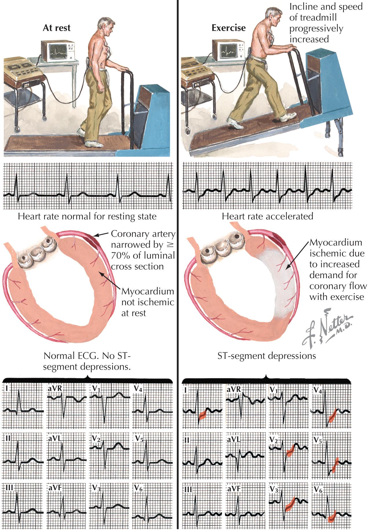 FIG 19.6, Stress-ECG Testing to Detect Myocardial Ischemia.