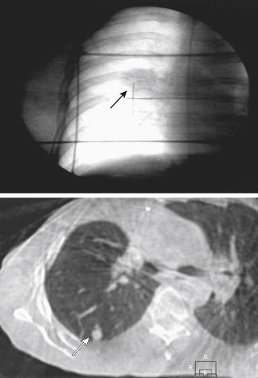 Fig. 37.1, Some techniques used for image guidance in stereotactic ablative radiotherapy for lung cancer, showing tumor visualization using a cone-beam computed tomography and implanted fiducial markers.