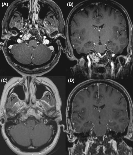 Figure 20.1, Preoperative axial (A) and coronal (B) magnetic resonance imaging (MRI) showing a chondrosarcoma of the petrous apex and postoperative axial (C) and coronal (D) MRI showing complete resection from a middle fossa approach.