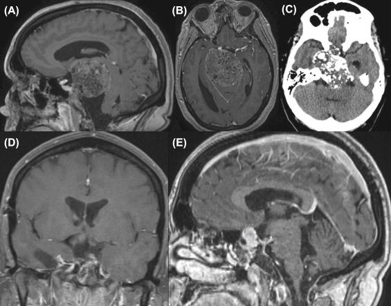 Figure 20.2, Preoperative sagittal (A) and axial (B) magnetic resonance imaging (MRI) and axial computed tomography (C) showing a giant chondrosarcoma and postoperative axial (D) and sagittal (E) MRI showing the extensive resection from a middle fossa approach.