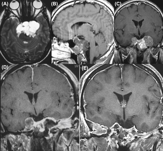 Figure 20.3, (A) Preoperative T2 magnetic resonance imaging (MRI) showing the extensive involvement of the clivus and both cavernous sinuses. (B) Sagittal enhanced MRI showing the elongated involvement of the clivus necessitating an anterior approach. (C) Coronal MRI showing involvement and lateral expansion of both cavernous sinuses. (D) Axial T2 MRI showing the spread to the left infratemporal fossa necessitating a left-sided zygomatic approach. (E) Coronal MRI following left-sided approach showing complete removal of the left-sided cavernous sinus involvement. (F) Coronal MRI following all three stages showing the final radical resection.