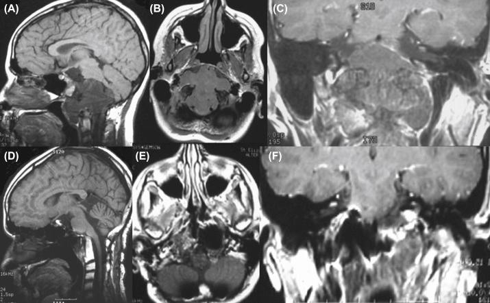 Figure 20.4, (A) Sagittal, (B) axial, and (C) coronal magnetic resonance imaging (MRI) showing a large clival chordoma extending into the occipital condyle; postoperative (D) sagittal, (E) axial, and (F) coronal MRI showing radical resection.