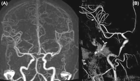 Figure 20.5, (A) Dynamic computed tomographic angiography and (B) formal angiography with three-dimensional reconstruction showing radiation-induced angiopathy of the carotid artery.