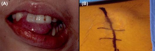 Figure 20.6, (A) Surgical seeding of chordoma in the oral cavity following an anterior midline approach. (B) Surgical seeding at the site of prior abdominal fat graft.