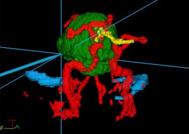 Figure 20.7, Segmentation reconstruction with merging of magnetic resonance imaging and computed tomographic angiography to clearly depict the tumor’s relationship to the carotid arteries.