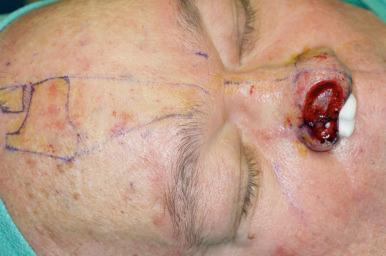 Fig. 8.3, Paramedian forehead flap—Flap template designed to include the eventual removal of nasal tip and alar subunit.