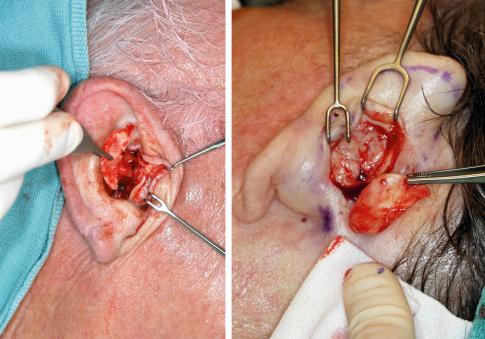 Fig. 8.6, Conchal cartilage harvested from either anterior or posterior approach.