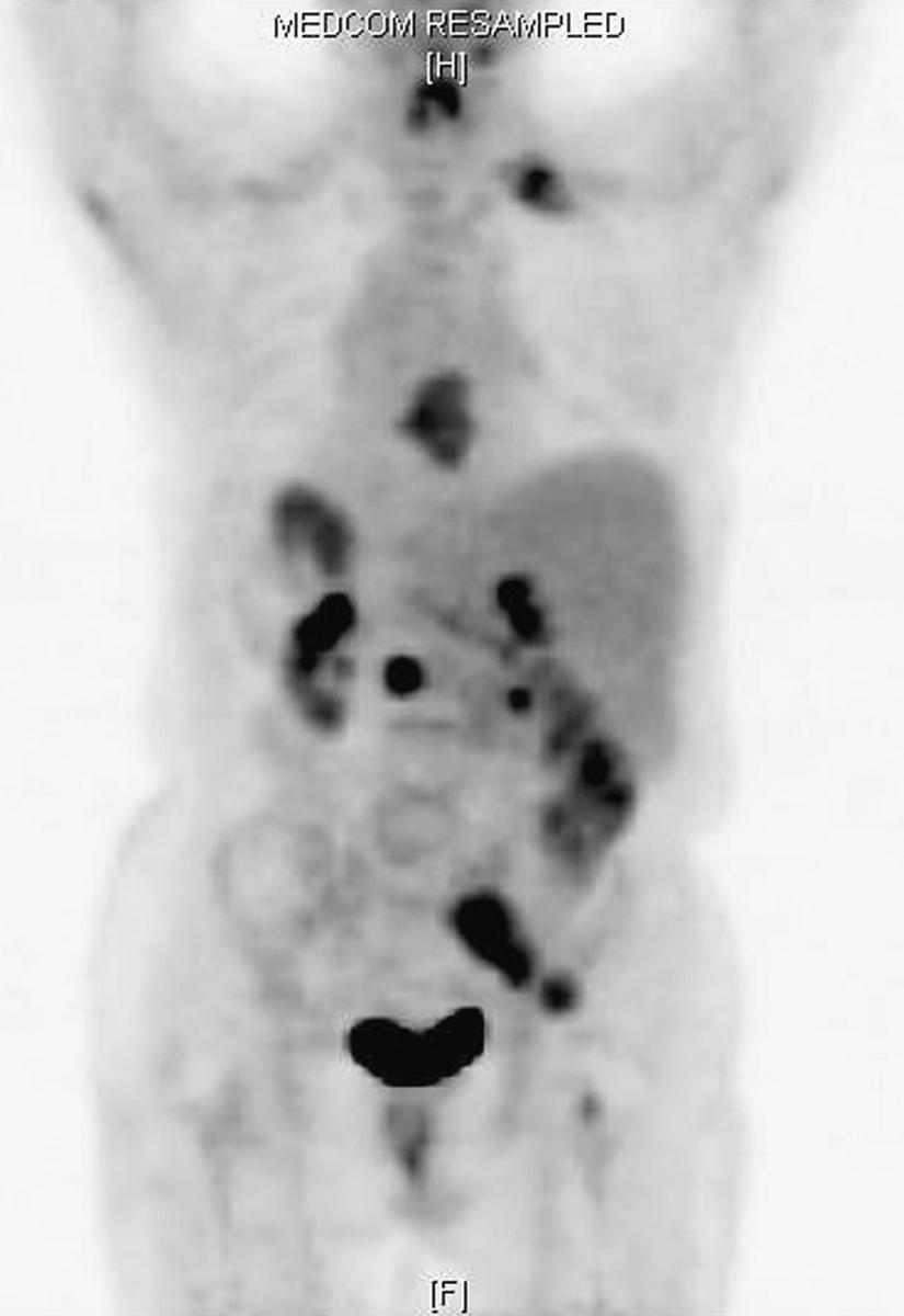 Fig. 154.11, Whole-body representation generated from a positron emission tomography/computed tomography showing multiple areas of osseous metastatic disease ( dark ) in a patient with thyroid cancer.