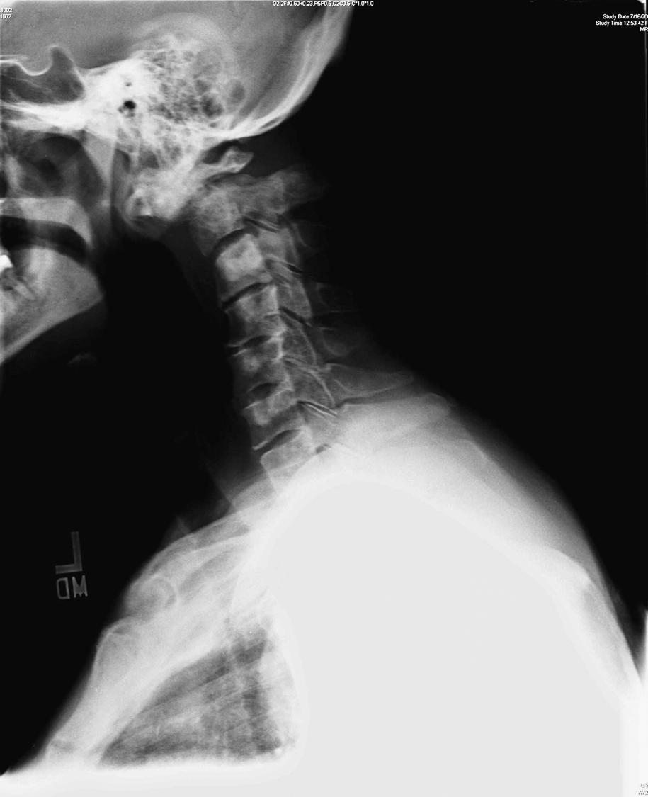 Fig. 154.2, Mechanical instability. Lateral cervical spine plain radiograph showing fracture-subluxation of C2 owing to metastatic renal cell carcinoma.