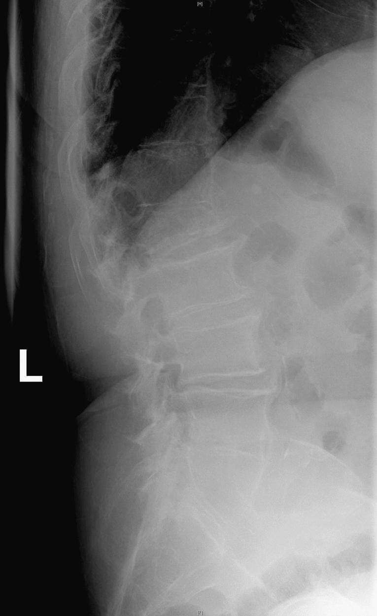 Fig. 154.3, Pathological compression fracture. Lateral thoracolumbar plain film showing L1 compression fracture attributed to multiple myeloma. Lesions at other levels, including T4 and T12, are not visualized on this film.