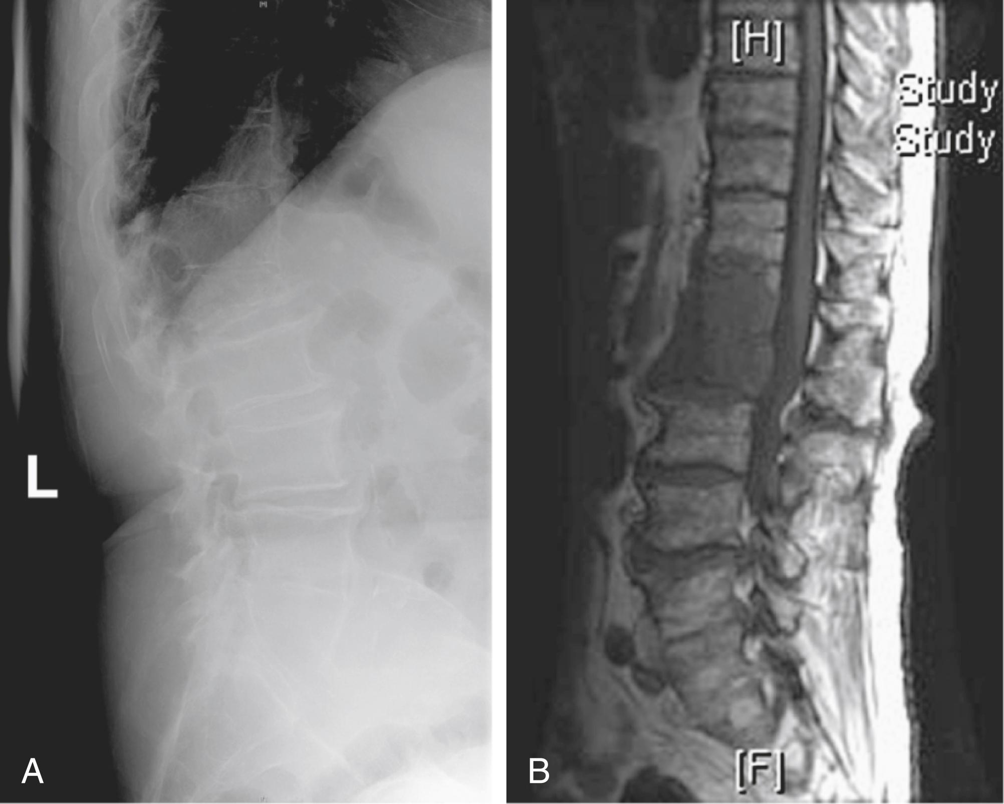 Fig. 154.5, Comparison of plain film to magnetic resonance imaging (MRI). A, Lateral plain radiograph of thoracolumbar spine showing a compression fracture at L1. This is the same film as Fig. 154.3. B, MRI showing disease at T12 and L1. The T12 disease could not be appreciated on the plain film.