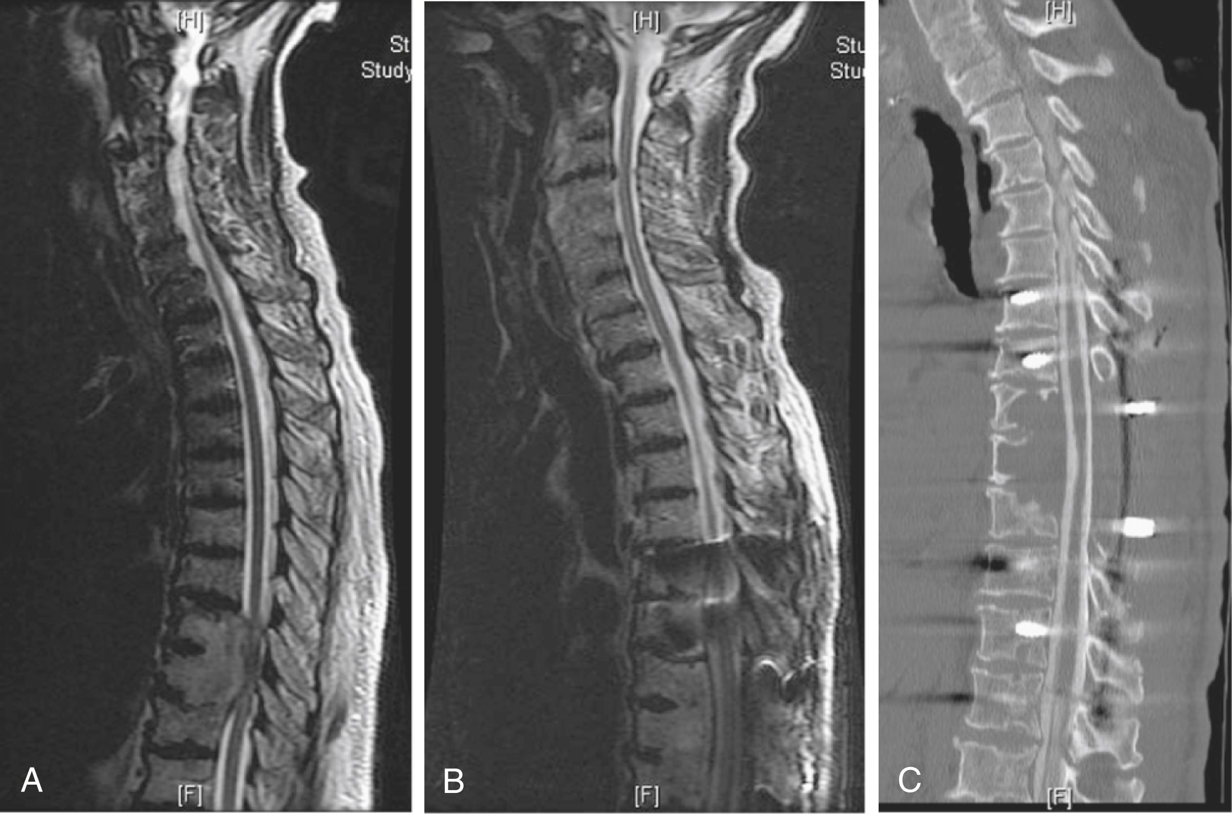 Fig. 154.7, Comparison of magnetic resonance imaging (MRI) and computed tomography (CT) myelogram after spine instrumentation. A, Preoperative T2-weighted MRI demonstrating severe spinal cord compression attributed to metastatic disease at T8‒T10. B, Postoperative T2-weighted MRI showing postsurgical changes and instrumentation. Note the artifacts caused by the pedicle screws that prevent complete visualization of the spinal canal. C, Postoperative CT myelogram allows better appreciation of the decompression of the thecal sac and spinal canal.