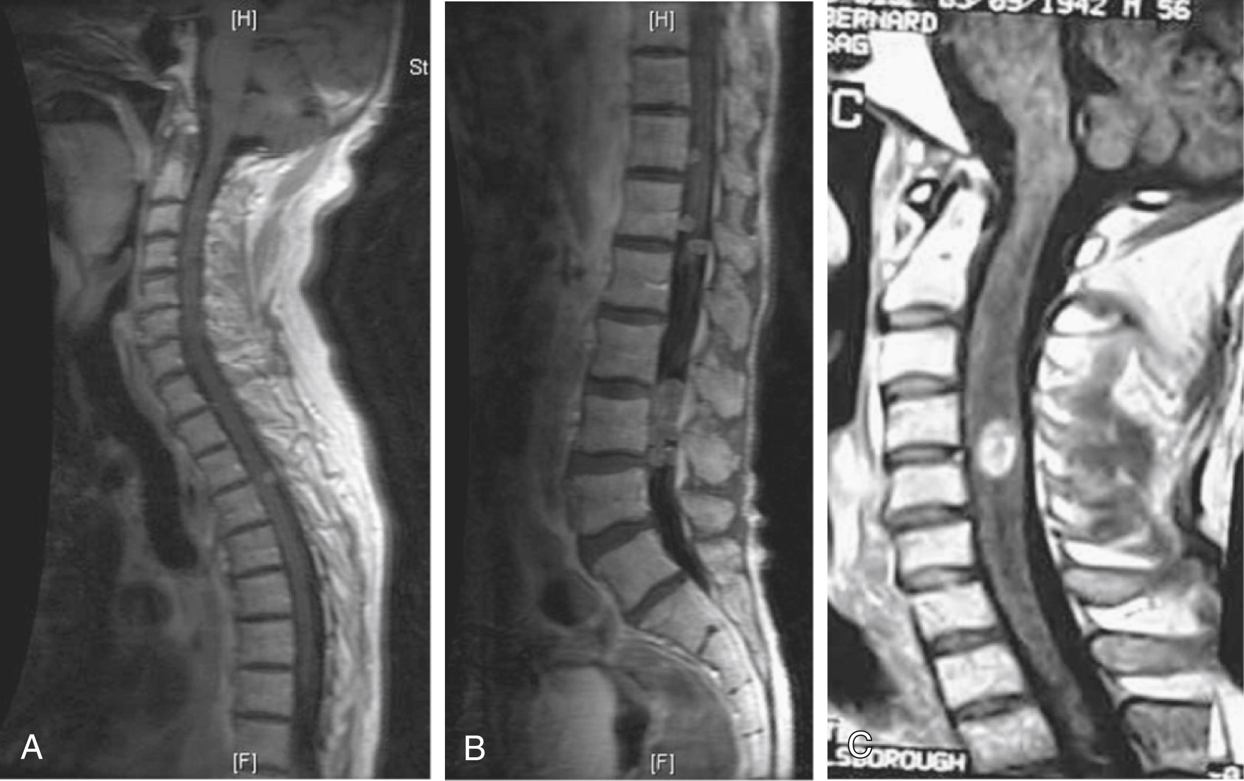 Fig. 154.8, T1-weighted magnetic resonance imaging after administration of gadolinium may reveal leptomeningeal disease or intramedullary metastases. Leptomeningeal disease is demonstrated at the T3‒T4 level ( A ) and the T11‒T12 and L2‒L4 levels ( B ) in a patient with gastric cancer. C, An intramedullary metastasis at the C4‒C5 level in a patient with prostate cancer.