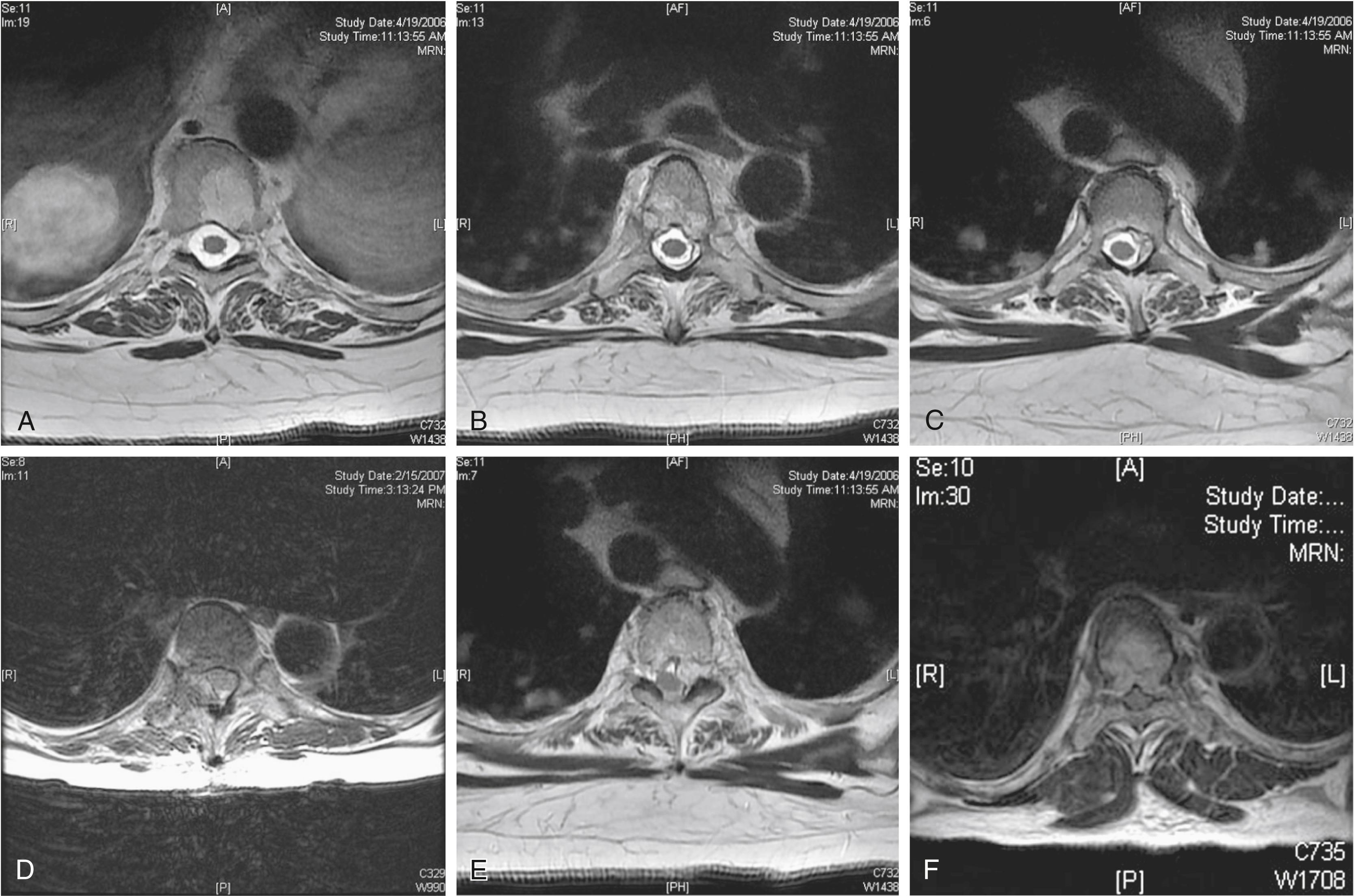 Fig. 154.10, The epidural spinal cord compression grading scheme is illustrated here with representative axial T2-weighted magnetic resonance imaging. Grade 1 is epidural disease without spinal cord compression and is divided into three grades. A, Grade 0—bone involvement only. B, Grade 1a—abutment of the thecal sac. C, Grade 1b—indentation of the thecal sac. D, Grade 1c—abutment of the spinal cord. E, Spinal cord compression or deformation, but cerebrospinal fluid (CSF) is still found at this level. F, Spinal cord compression with obliteration of all CSF space at this level.