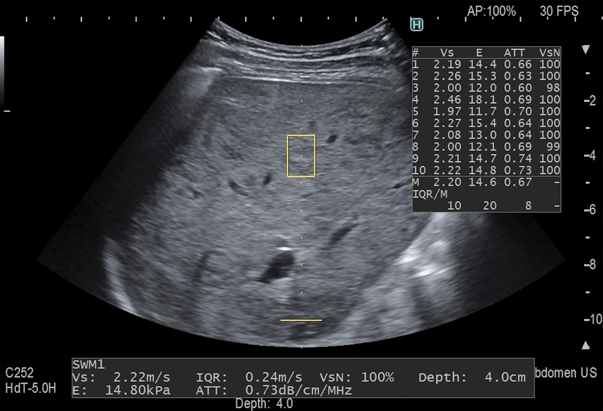Fig. 7.1, Asymptomatic 48-year-old woman with chronic hepatitis B and normal laboratory tests. A point shear wave elastography technique (SWM, Arietta 850 ultrasound system, Fujifilm Healthcare previously Hitachi Ltd) shows that the median liver stiffness value is 14.6 kPa, which indicates compensated advanced chronic liver disease. The measurement is of good quality (IQR/M: 20%), and the quality criterion provided by the manufacturer for each acquisition, VsN, is fulfilled for all acquisitions (range: 98%–100%). IQR/M, Interquartile range/median.