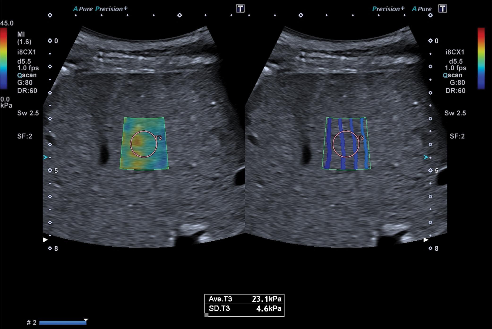 Fig. 7.2, Treatment-naïve 64-year-old man with chronic hepatitis C. The patient had had an episode of liver decompensation a month before the examination. The stiffness value obtained with a two-dimensional shear wave elastography technique (Aplio i800 ultrasound system, Canon Medical Systems) is 23.1 kPa, indicating a high likelihood of clinically significant portal hypertension. The measurement was taken following the quality criterion given by the manufacturer (i.e., the lines were parallel and equally spaced in the propagation map [right]) .