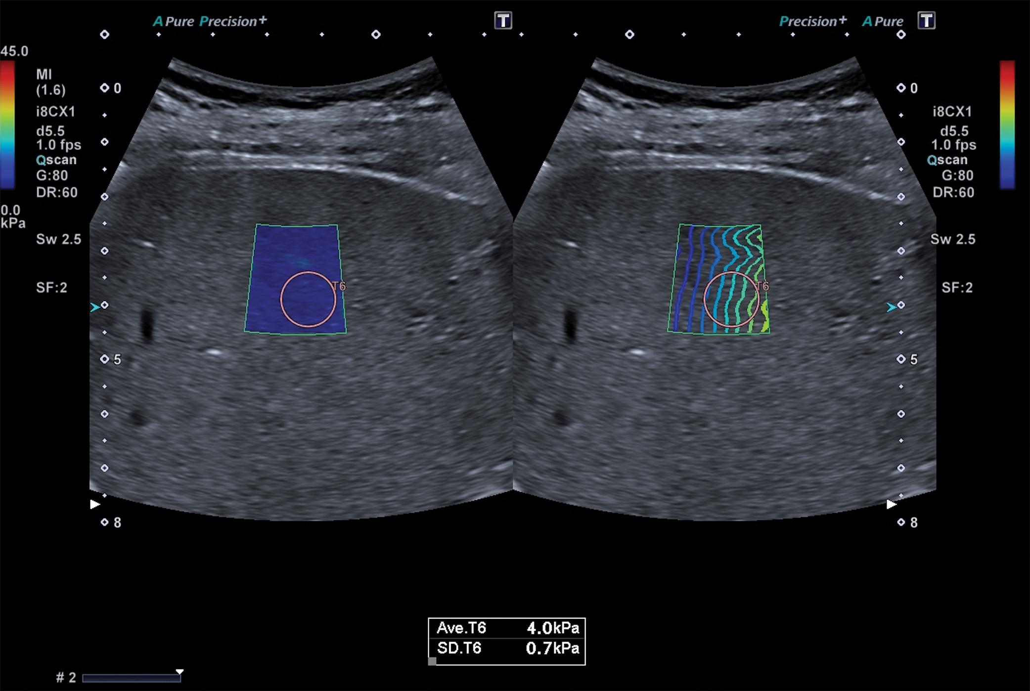 Fig. 7.3, Treatment-naïve 55-year-old woman with chronic hepatitis C. The stiffness value, obtained with the Canon two-dimensional shear wave elastography technique, is below 5 kPa. Therefore there is a high likelihood of absence of liver fibrosis.