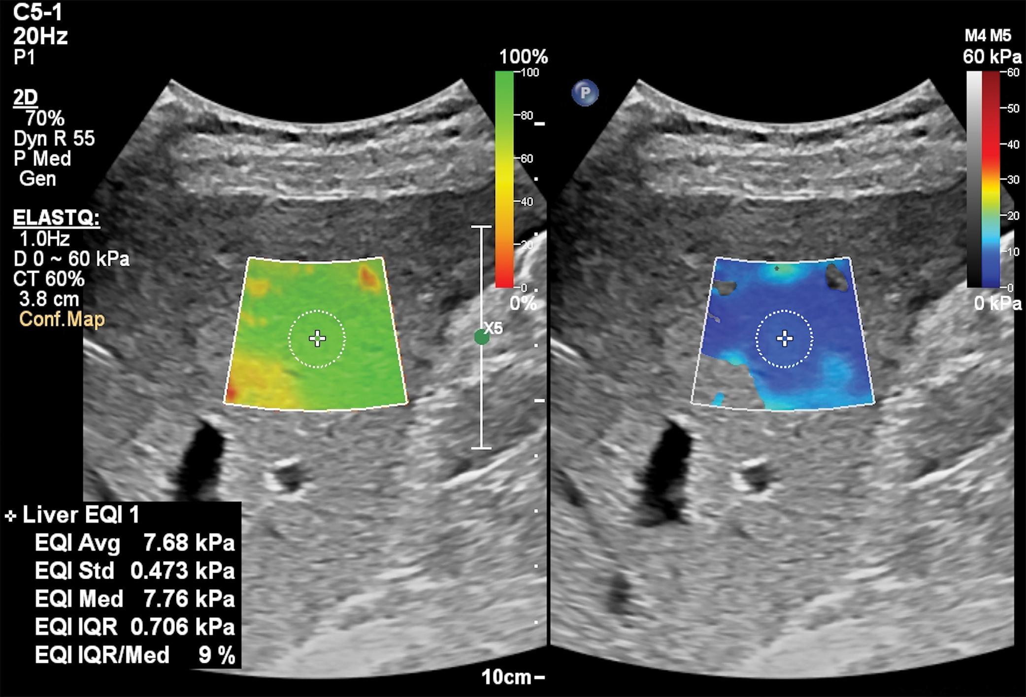 Fig. 7.4, A 35-year-old woman with chronic hepatitis B under antiviral treatment and with laboratory tests in the normal range. The liver stiffness obtained with a two-dimensional shear wave elastography technique (ElastQ, Epiq7 ultrasound system, Philips Medical Systems) is 7.68 kPa, a value that indicates significant fibrosis. The confidence map on the left side is used for positioning the measurement box in the best quality area, which is highlighted with the green color.