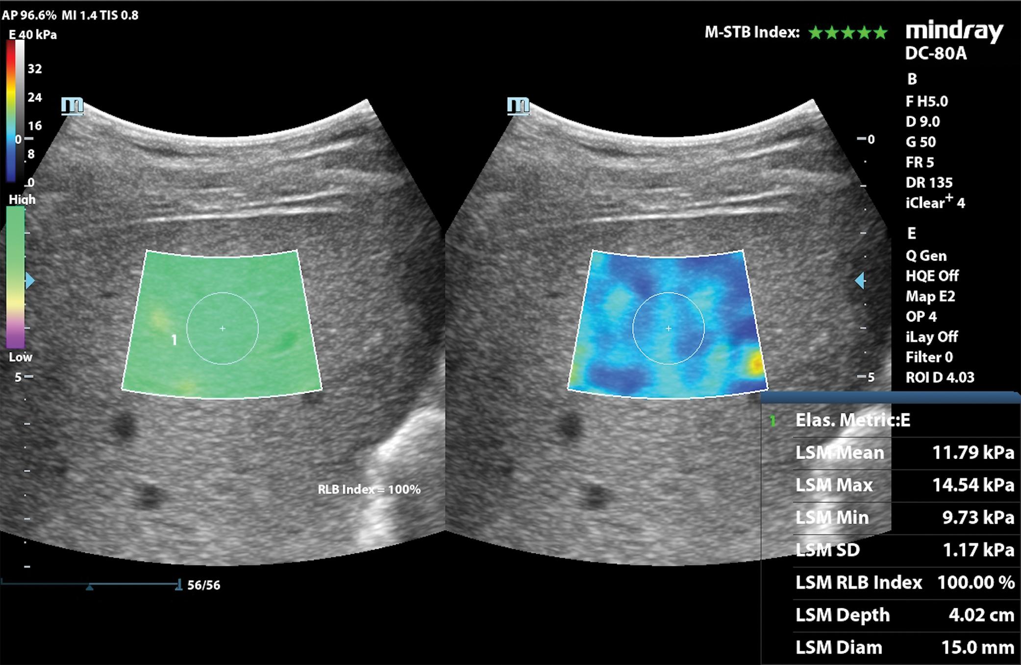 Fig. 7.5, Treatment-naïve 35-year-old man with chronic hepatitis C and normal laboratory tests. The liver stiffness obtained with a two-dimensional shear wave elastography technique (STE, DC-80A ultrasound system, Mindray Medical Systems) is 11.79 kPa, a value that is suggestive of compensated advanced chronic liver disease. The measurement was made in a reliable area, as indicated by the reliability map on the left, and no motion was detected, as indicated by the five green stars on the right top side of the image. Both reliability map and motion stability index are manufacturer’s quality criteria.