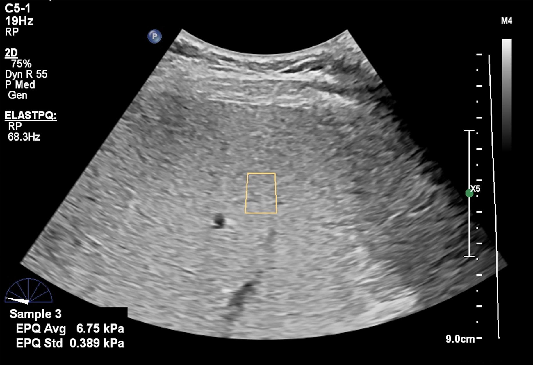 Fig. 7.6, Asymptomatic 42-year-old woman with nonalcoholic fatty liver disease and alanine aminotransferase value of 52 IU/L. The liver stiffness obtained with a point shear wave elastography technique (ElastPQ, Epiq7 ultrasound system, Philips Medical Systems) is 6.75 kPa, a value that may exclude significant fibrosis. The manufacturer quality criterion is the standard deviation of each measurement shown below the average value on the left bottom side of the image. It must be up to 30% of the average value.