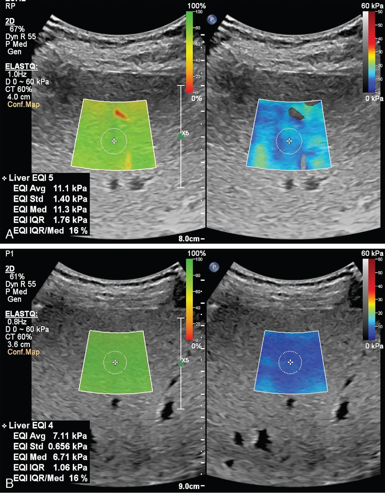 Fig. 7.7, A 67-year-old man with compensated advanced chronic liver disease due to hepatitis C virus infection. (A) Baseline two-dimensional shear wave elastography technique (ElastQ, Epiq7 ultrasound system, Philips Medical Systems) performed a few days before starting direct-acting antiviral treatment shows a liver stiffness value of 11.1 kPa, which indicates advanced fibrosis. (B) The assessment of liver stiffness after 1 month of treatment showed that liver stiffness had decreased by 3.99 kPa. This rapid decrease is likely due to resolution of inflammation.