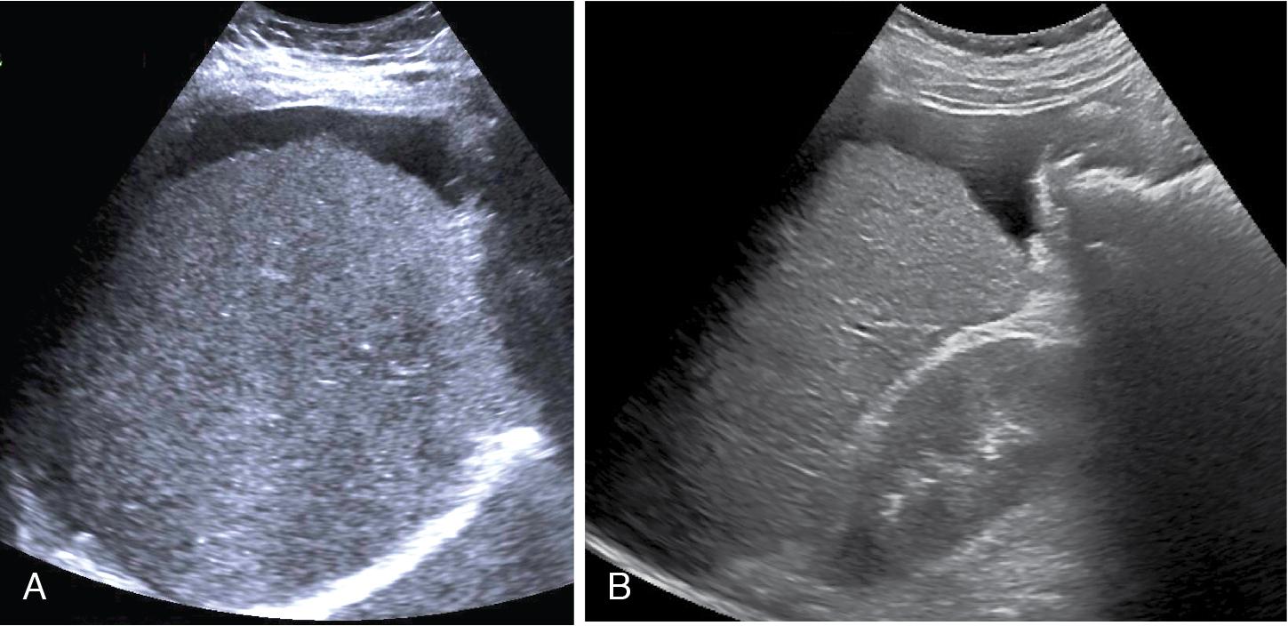 Fig. 7.8, Pretreatment image of a 66-year-old man with decompensated cirrhosis from chronic hepatitis C virus (A). At that time the patient’s liver stiffness was 25 kPa. On follow-up 11 months post–direct-acting antiviral treatment, his liver stiffness decreased to 15 kPa, 16 months posttreatment it decreased to 11.5 kPa, and 2 years posttreatment it decreased to 7.4 kPa. However, despite the good liver stiffness response to treatment, the patient still remained in decompensated cirrhosis (B).