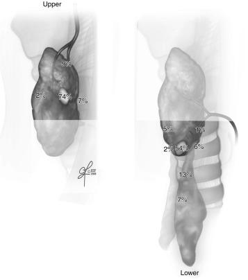 Fig. 56.2, Normally expected distribution of upper and lower parathyroid glands.