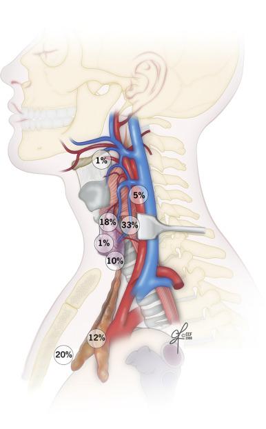 Fig. 56.3, Distribution of ectopic parathyroid glands.