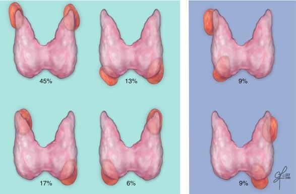Fig. 56.4, Double parathyroid adenomas have nonuniform distribution that favors enlargement of both upper glands. Only a minority (18%) will have ipsilateral location.