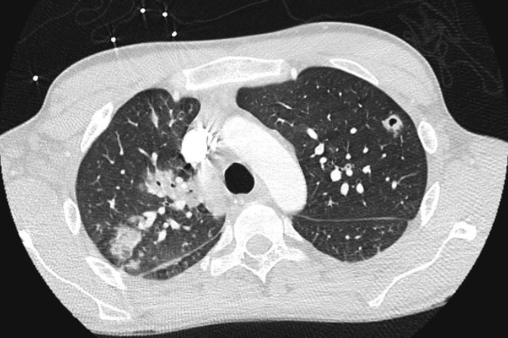 FIGURE 267-1, Computed tomography (CT) of the chest shows multiple nodular pulmonary lesions with areas of cavitation, suggestive of septic embolization, in a patient with tricuspid valve S. aureus endocarditis.