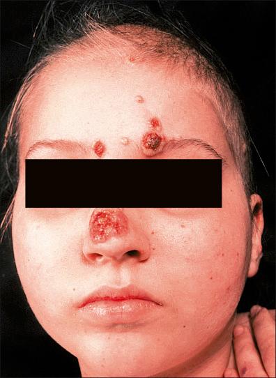 Figure 21-1, Impetigo contagiosa. Several plaques with yellowish crusts on the face.