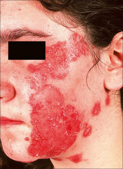 Figure 21-2, Tinea in the face complicated by impetigo. Sharply demarcated erythema with yellowish crusts on the left cheek.