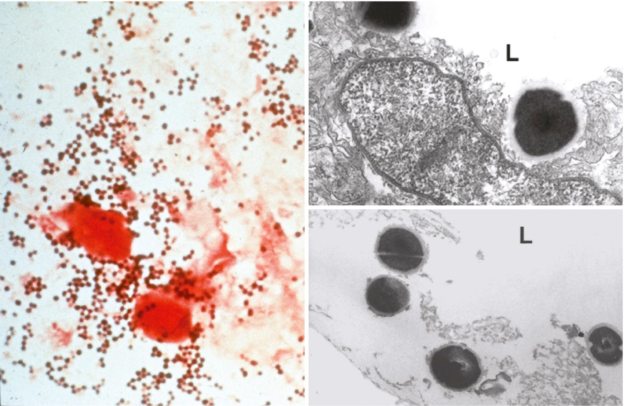 FIG. 194.1, Gram staining and transmission electron microscopy of clinical samples of Staphylococcus aureus.