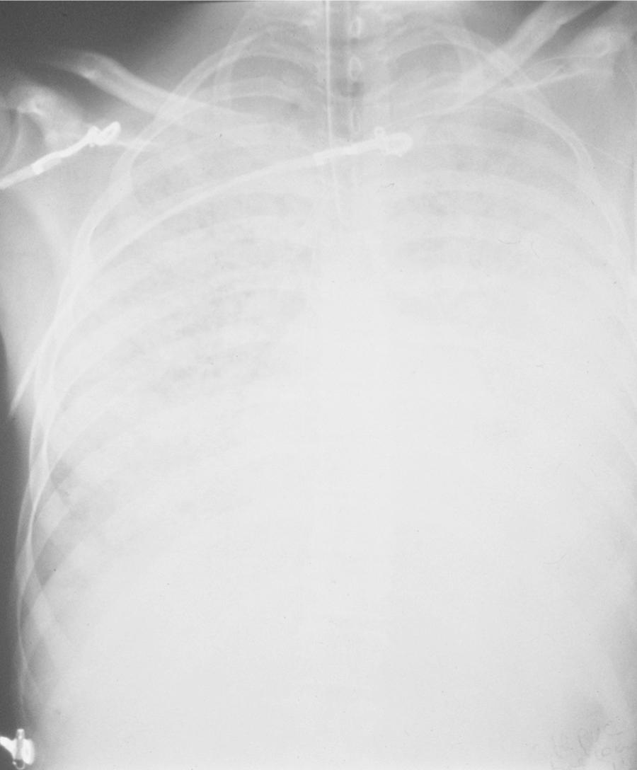 FIG. 194.8, Fulminant hemorrhagic pneumonia in 20-year-old patient infected with Panton-Valentine leukocidin–producing Staphylococcus aureus .