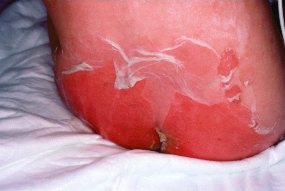 FIG. 194.9, Staphylococcal scalded skin syndrome.