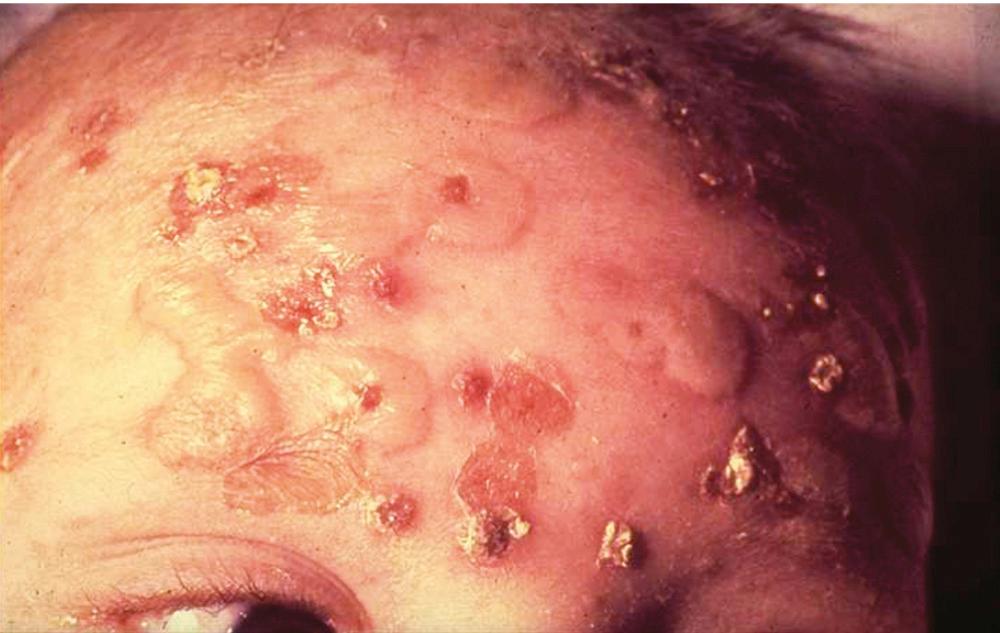 FIG. 194.10, Localized staphylococcal scalded skin syndrome, also called bullous impetigo.