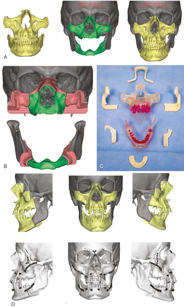 Figure 63.1, (A) Virtual surgical planning used to simulate the bony cuts in a face transplant on two cadaver heads. (B) Based on the planned osteotomies, cutting guides are made that are placed on the bones. These guides allow for improved accuracy of the cuts to allow for a better and more efficient reconstruction. This image shows the cutting guides used for the recipient and (C) cutting guides for the donor (D). (Top) Lateral and AP views of the planned reconstruction. (Bottom) Lateral and AP views following the reconstruction demonstrating accuracy of the reconstruction.