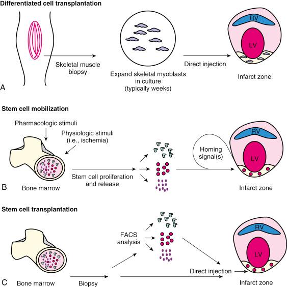 Fig. 61.1, Schematic diagram of (A) differentiated cell transplantation, (B) stem cell mobilization, and (C) stem cell transplantation strategies of cell therapy for the treatment of cardiac dysfunction. FACS , Fluorescence-activated cell sorting; LV , left ventricle; RV , right ventricle.