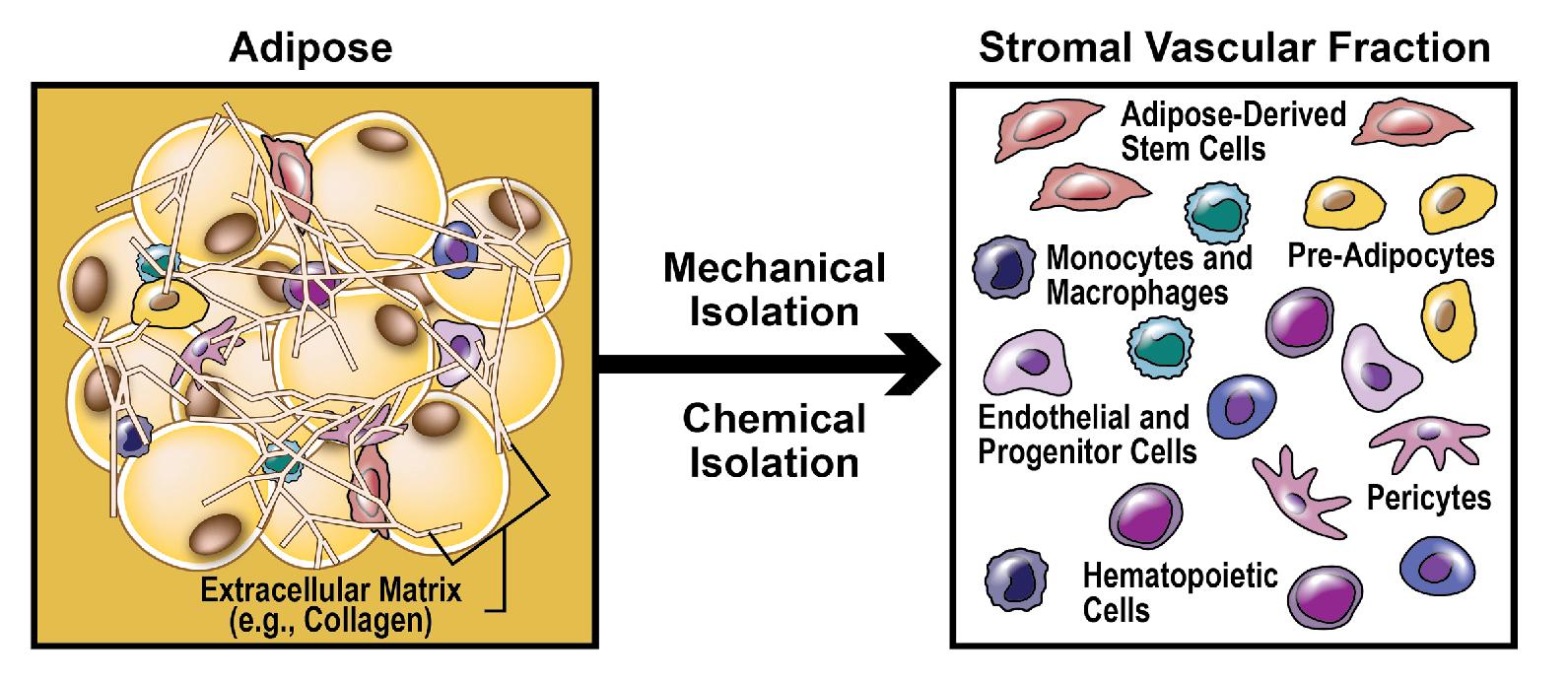 Fig. 13.2, Adipose tissue may be processed into stromal vascular fraction (SVF) by enzymatically or nonenzymatically removing adipocytes and connective tissue, leading to a higher concentration of adipose-derived stem cells (ADSCs) in SVF than found in unprocessed adipose. SVF contains other stem cells (e.g., ADSCs, hematopoietic stem cells, pericytes), progenitor cells (e.g., adipocyte progenitors), mature cells (e.g., endothelial cells, erythrocytes, immune cells, smooth muscle cells, fibroblasts), and an abundance of growth factors and other secreted molecules.