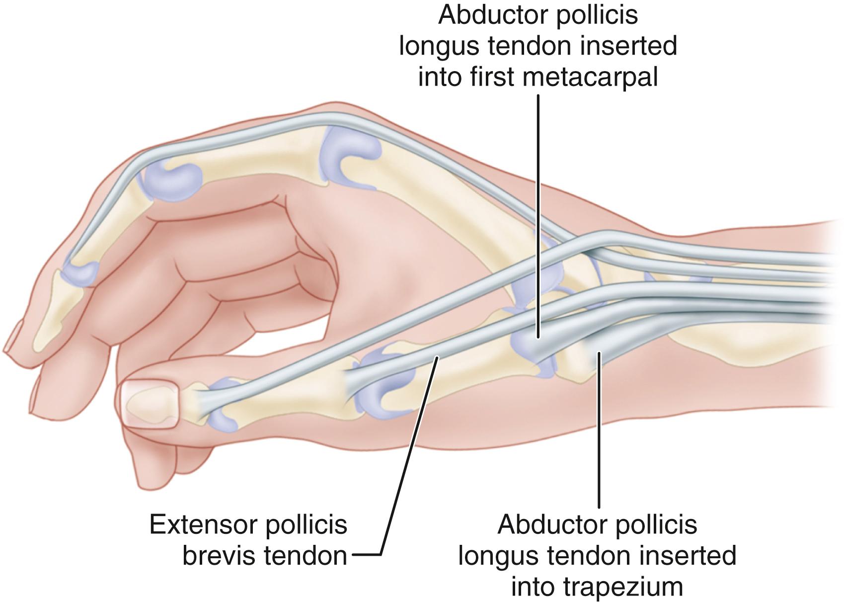 FIGURE 76.2, During surgery for de Quervain disease, at least one aberrant tendon often is found. Abductor pollicis longus routinely inserts on first metacarpal base and commonly has thenar fascial slip.