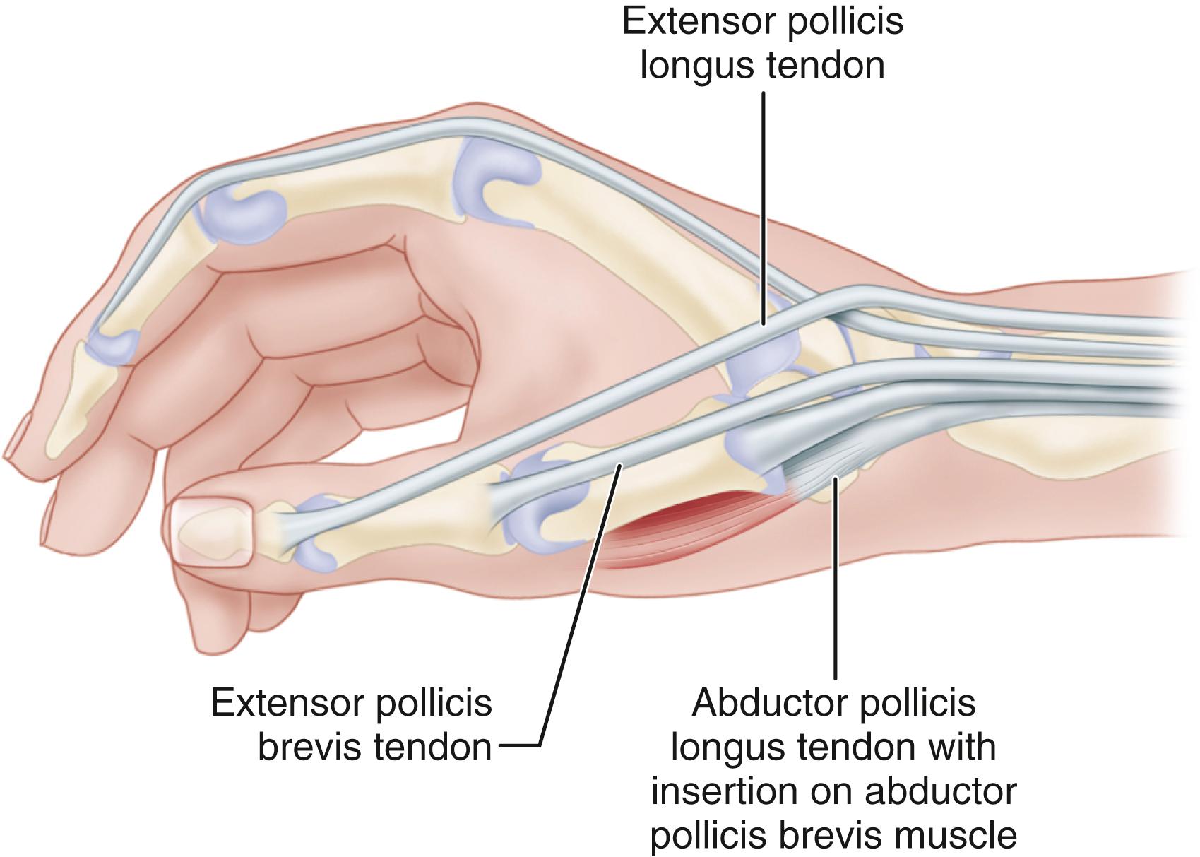 FIGURE 76.3, In rare cases, abductor pollicis longus inserts onto trapezium.