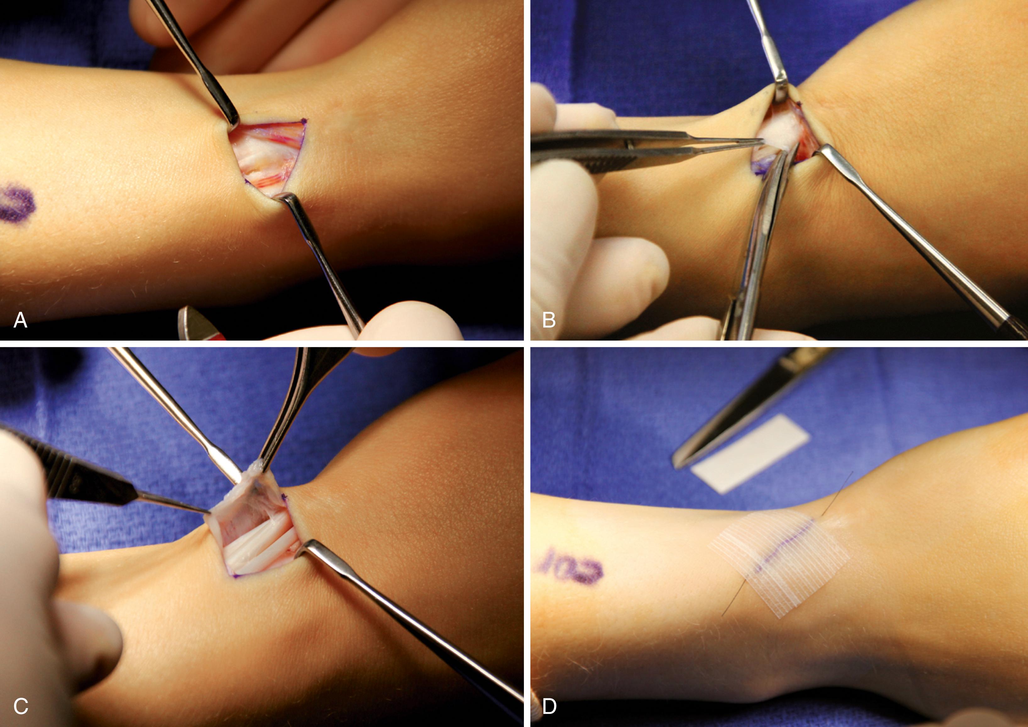 FIGURE 76.4, Surgical treatment of de Quervain disease. A , Skin incision. B , Dorsal carpal ligament has been exposed. C , First dorsal compartment has been opened on its ulnar side. D , Occasionally, separate compartments are found for extensor pollicis brevis and abductor pollicis longus tendons SEE TECHNIQUE 76.1.