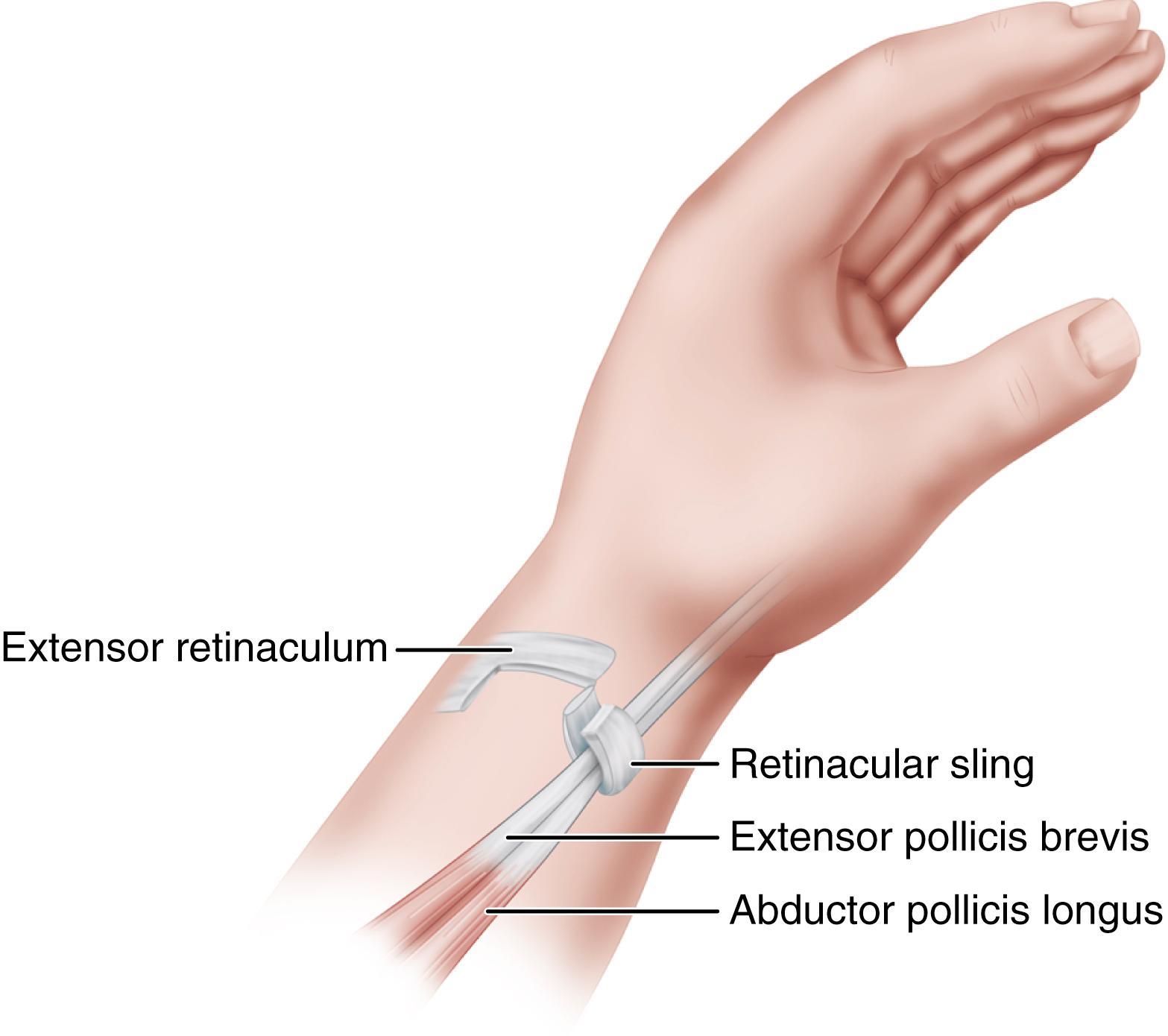 FIGURE 76.5, Part of extensor retinaculum is used to create U-shaped sling to retain tendons of extensor pollicis brevis and abductor pollicis longus.