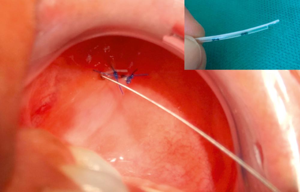 Fig. 25.1, Suture attachment of the stent to the to the inner cheek.