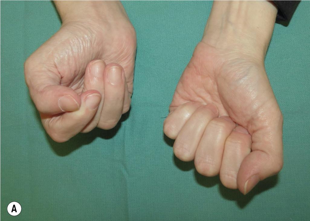 FIGURE 100.1, (A–B) Mild flexion contracture with active finger extension preserved.