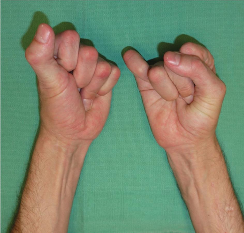 FIGURE 100.2, Severe flexion contracture, unable to extend fingers.