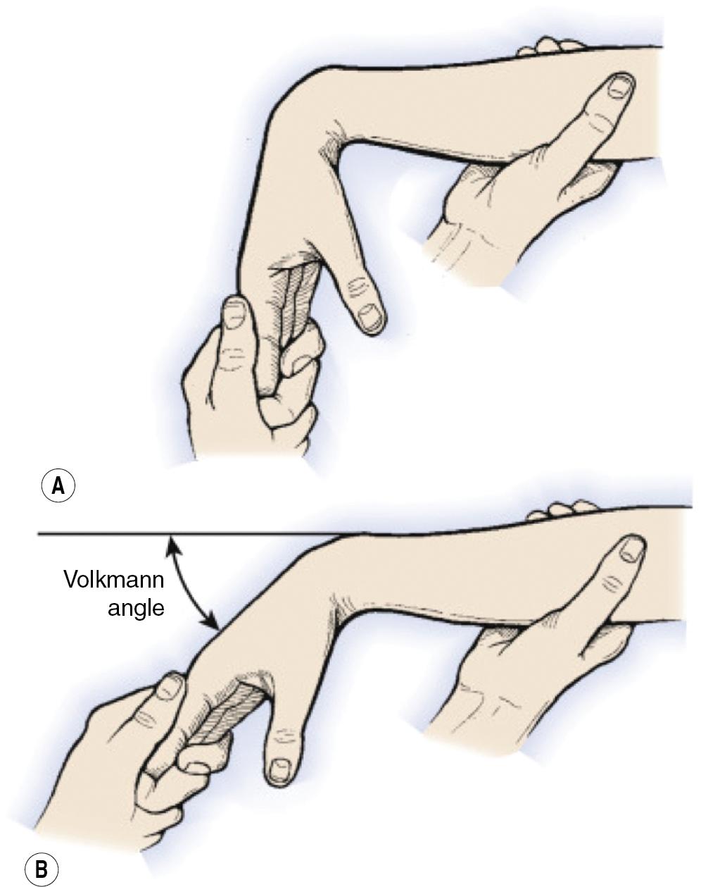 FIGURE 100.3, (A–B) Volkmann’s test.