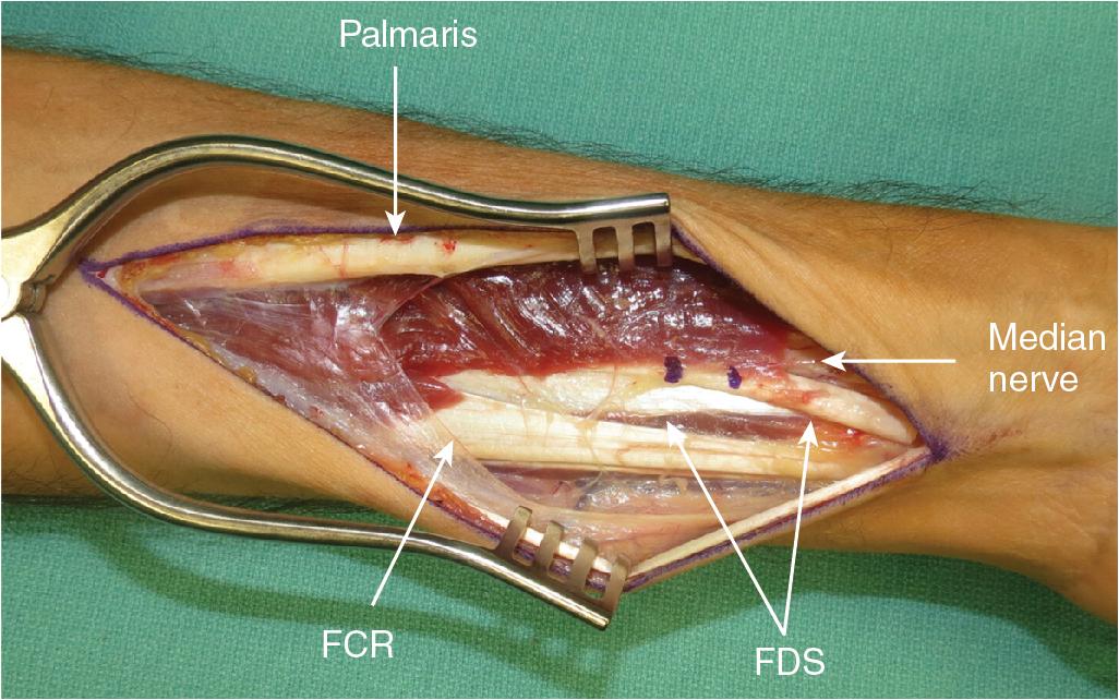 FIGURE 100.4, Key anatomic structures in the forearm.