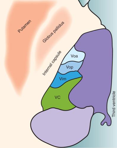 Figure 58.1, Axial schematic depicting the basal ganglia and thalamus: thalamic motor nuclei are ventralis oralis anterior (Voa), ventralis oralis posterior (Vop), and ventralis intermedius (Vim); thalamic sensory nuclei are within the ventrocaudal nucleus (VC), which includes the ventroposterolateral (VPL) and ventroposteromedial (VPM) nuclei.